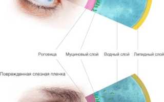 Что такой синдром сухого глаза