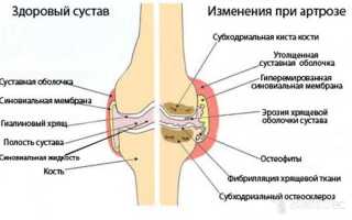 Артрит локтевого сустава код мкб