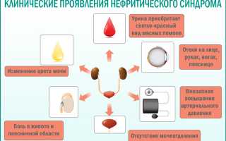 Нефротический и нефритический синдромы отличия таблица