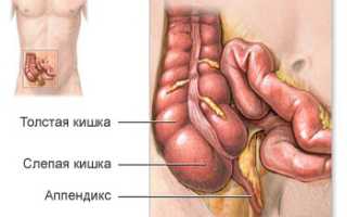 Синдром подвижной слепой кишки симптомы