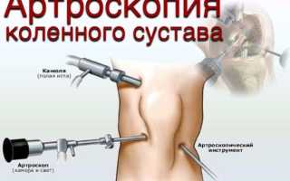 Код мкб повреждение медиального мениска