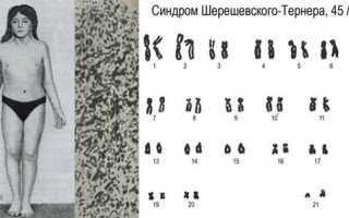 Кратко о синдроме шерешевского тернера