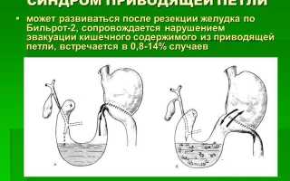 Что такое синдром приводящей кишки
