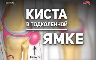 Киста беккера под коленом код по мкб
