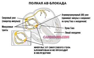 Синдром фредерика и его лечение