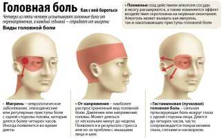 Синдром вегетативной дисфункции с цефалгией
