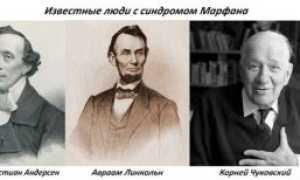 Синдром марфана фото больных людей на ранней стадии