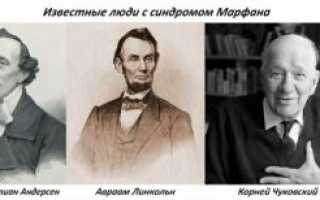Синдром марфана фото больных людей на ранней стадии