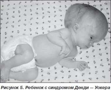 Синдром денди уокера у детей