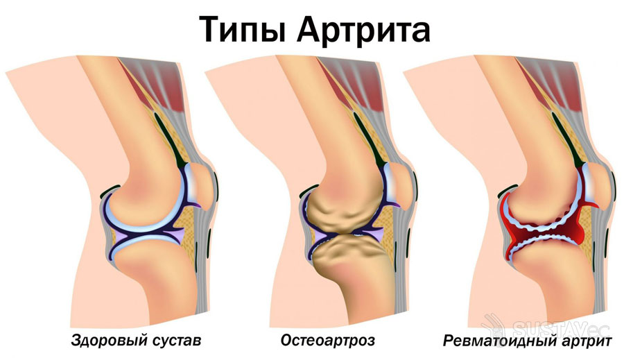 Симптомы и лечение артрита локтевого сустава 16-2