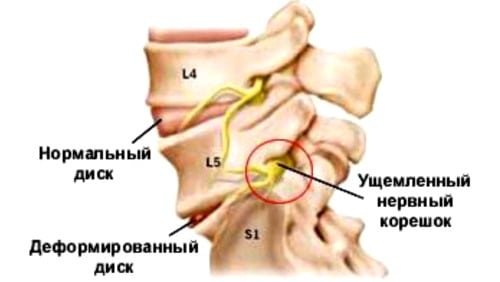 Корешковый синдром на фоне остеохондроза
