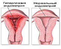 N85.0 Железистая гиперплазия эндометрия