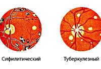 Хориоретинит
