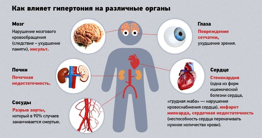 Синдром позвоночной артерии код по мкб 10 у взрослых