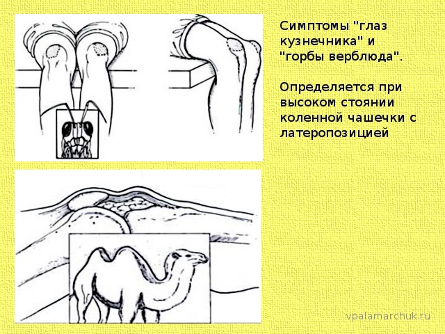 симптомы высокого стояния коленной чашечки 