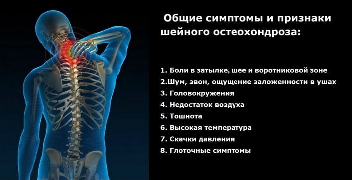 Корешковый синдром на фоне остеохондроза