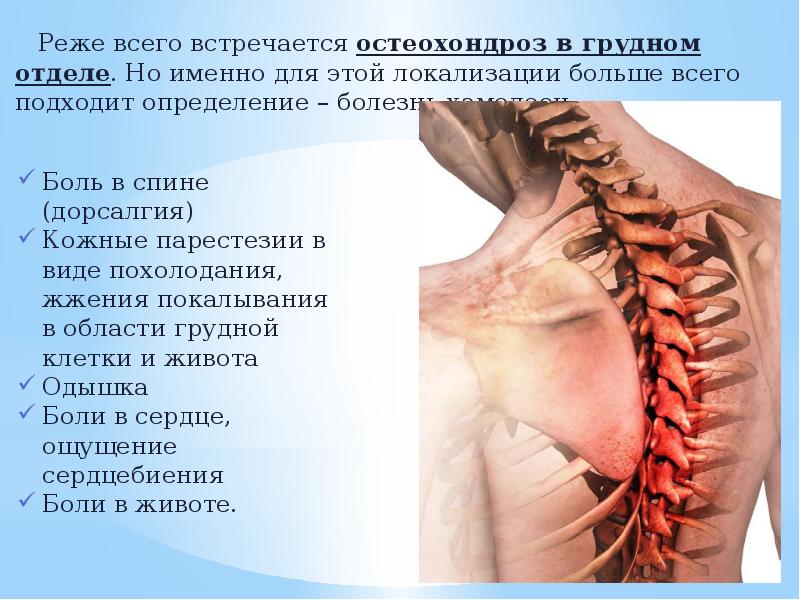 Корешковый синдром на фоне остеохондроза