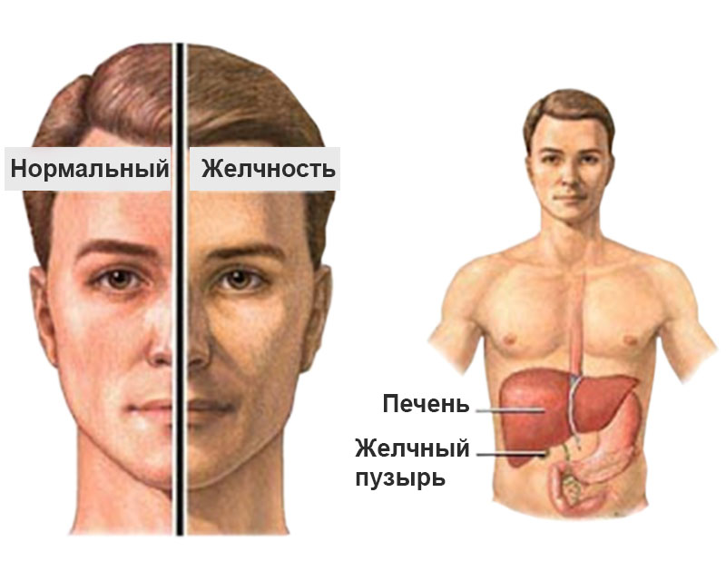 Симптомы синдрома Жильбера