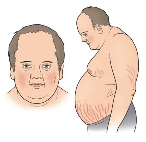 Синдром кушинга у человека фото