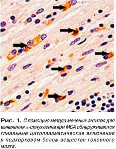 Мультисистемная атрофия (гистология)