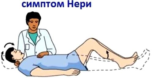 Корешковый синдром на фоне остеохондроза
