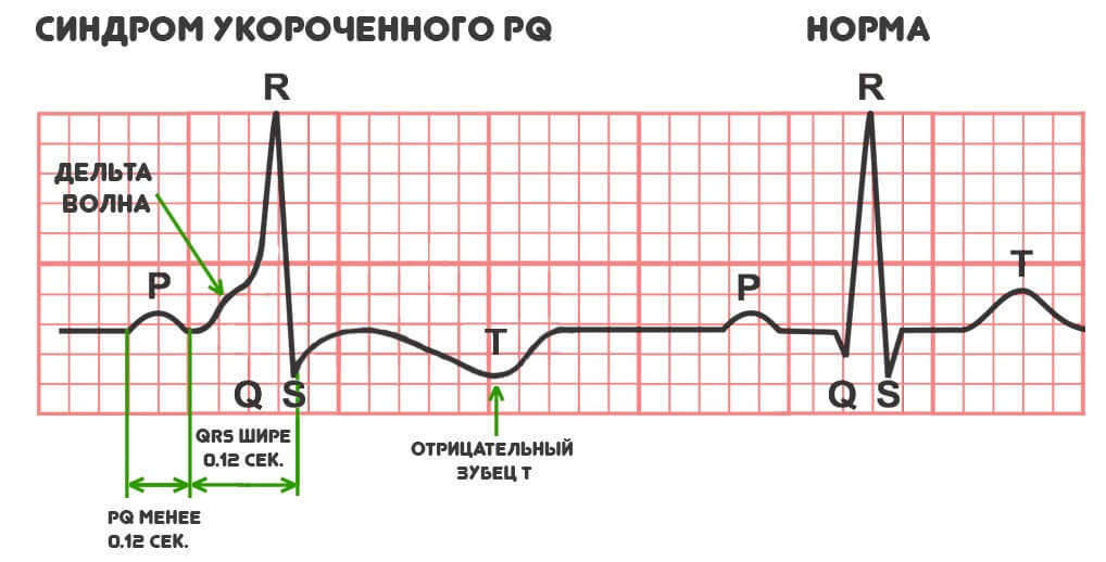 Мкб 10 синдром укороченного pq