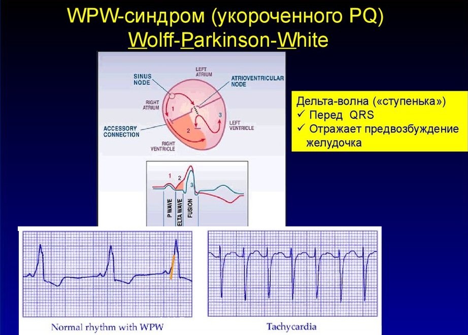 Мкб 10 синдром укороченного pq