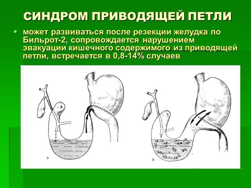 Синдром приводящей петли 